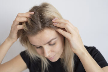 woman having dandruff on her hand